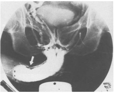 Farmacovernosograma de un paciente con induratio penis plastica y disfunción eréctil