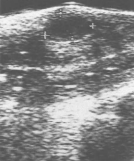Imagen ecográfica de un hematoma encapsulado subcutáneamente (flechas) tras una rotura peneana